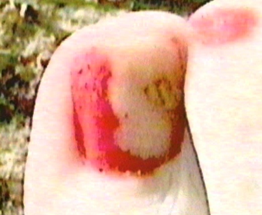 from-lili-whites-snake-foot-toenail